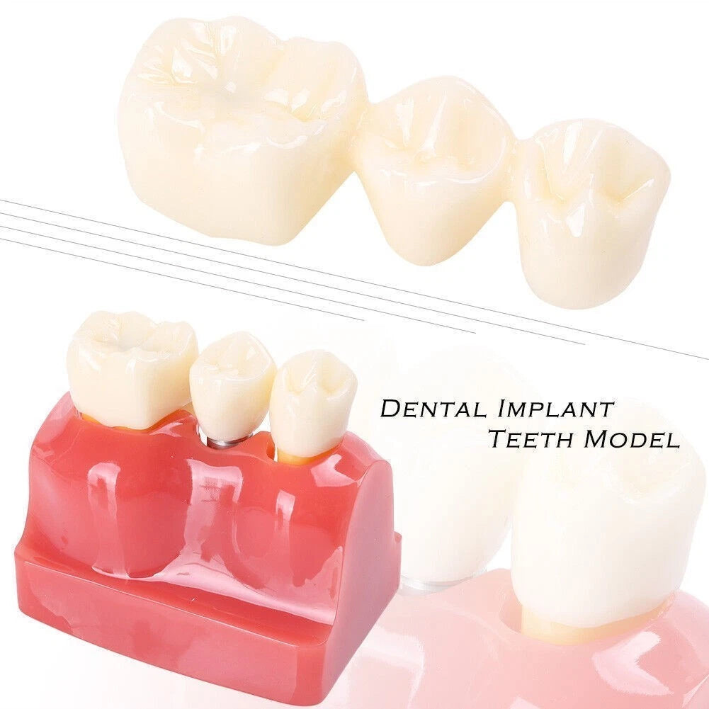 Dental Implant Analysis Crown Bridge Teeth Model for Study