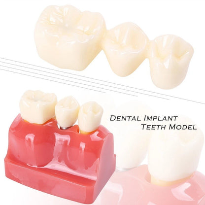 Dental Implant Analysis Crown Bridge Teeth Model for Study