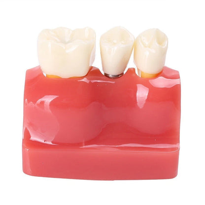 Dental Implant Analysis Crown Bridge Teeth Model for Study