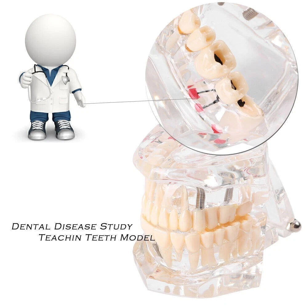 Dental Study Teeth Model for Adult Pathological Disease