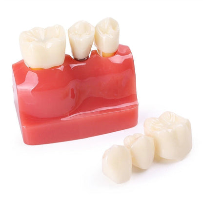 Dental Implant Analysis Crown Bridge Teeth Model for Study