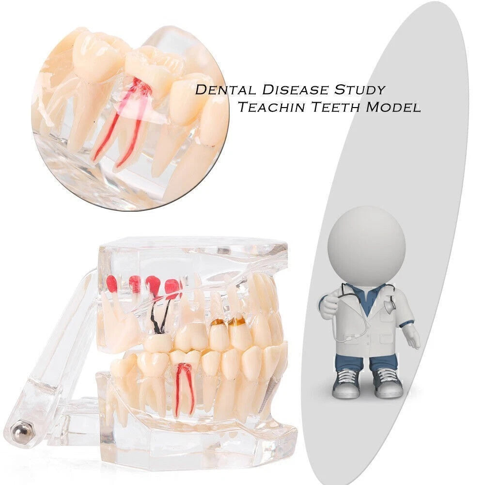 Dental Study Teeth Model for Adult Pathological Disease