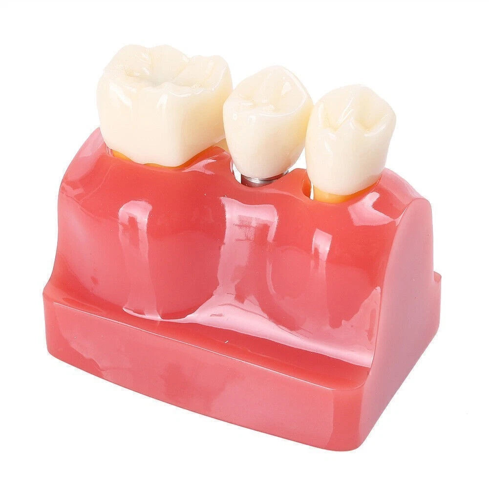 Dental Implant Analysis Crown Bridge Teeth Model for Study