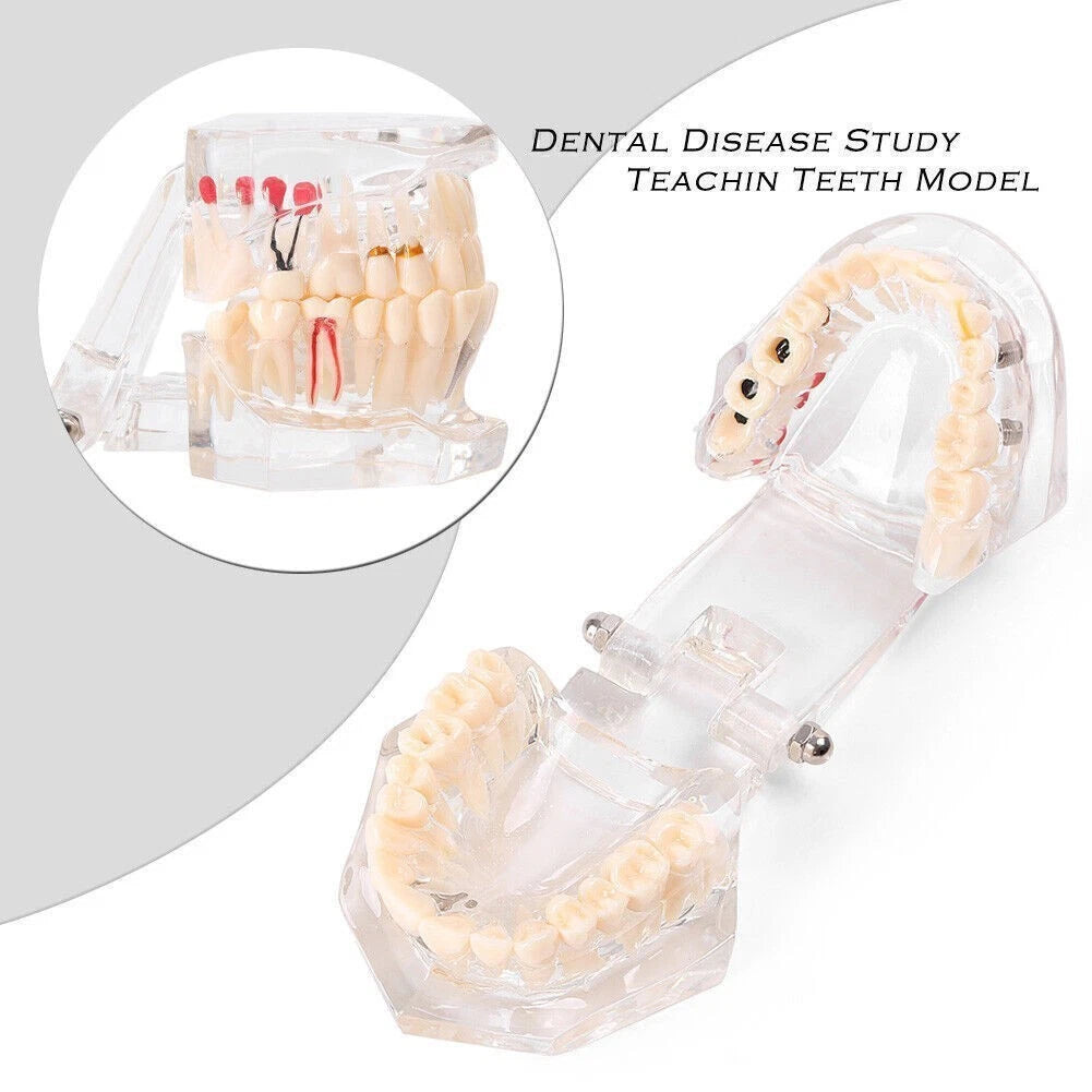 Dental Study Teeth Model for Adult Pathological Disease