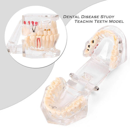 Dental Study Teeth Model for Adult Pathological Disease