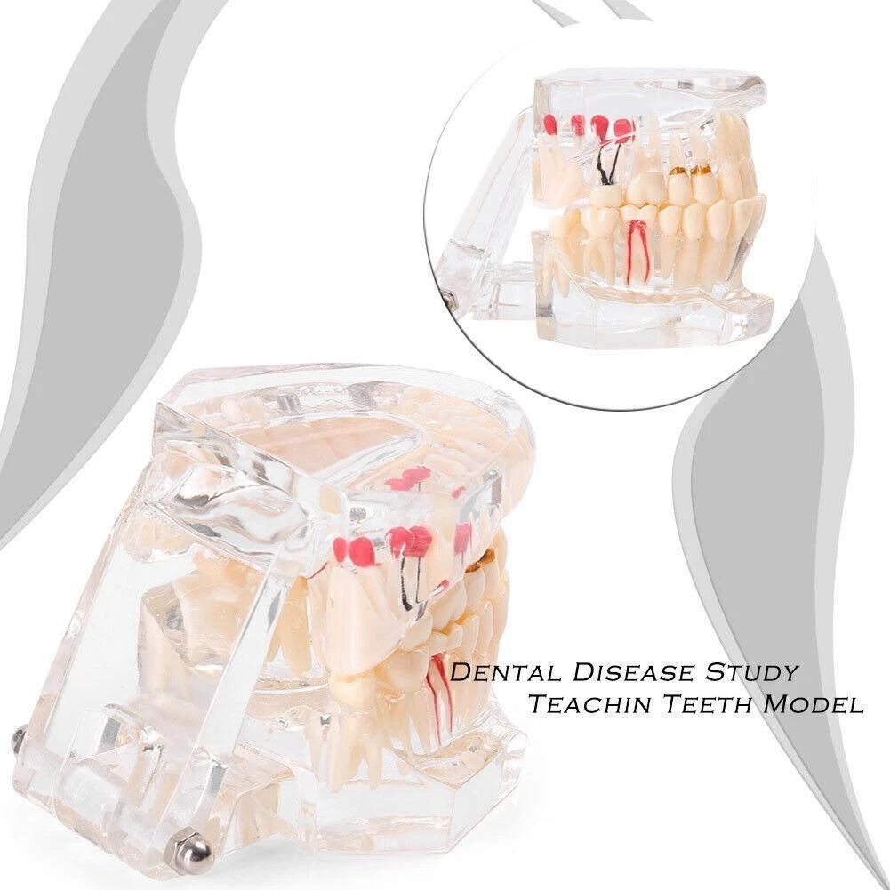 Dental Study Teeth Model for Adult Pathological Disease