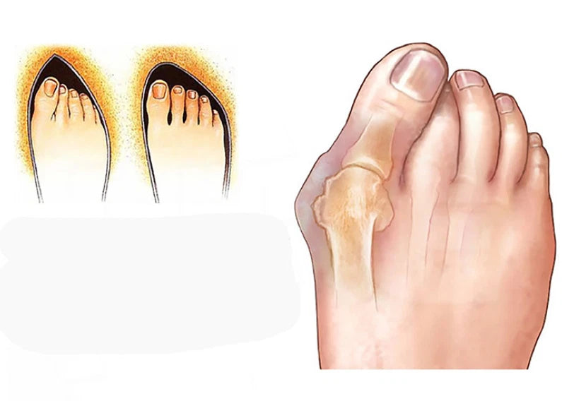 1 Pair Silicone Gel Toe Bunion Spreader for Universal Fit